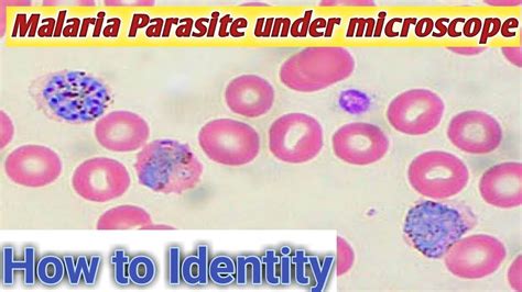  Plasmodium: Um Parasita Microscópico que Faz Tremer o Mundo! 